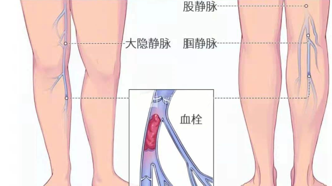 深靜脈血栓類似病癥的認(rèn)識(shí)與區(qū)分