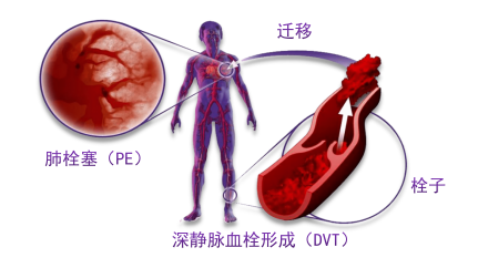 骨科術(shù)后重點(diǎn)關(guān)注的問題—VTE，該如何防治？