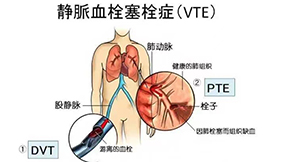 哪些人容易發(fā)生靜脈血栓栓塞癥（VTE）