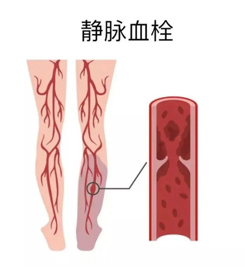 血栓是心梗、腦梗的元兇，很容易找上這些人