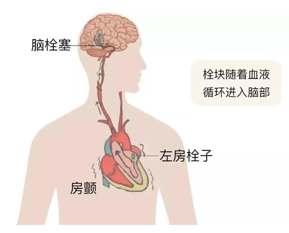 血栓是心梗、腦梗的元兇，很容易找上這些人