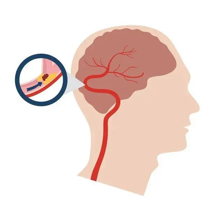 血栓是心梗、腦梗的元兇，很容易找上這些人