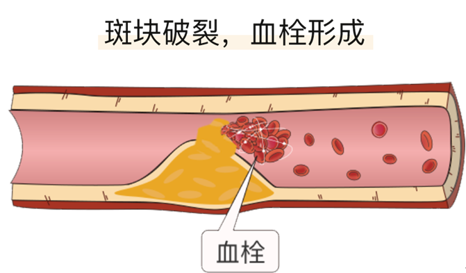 血栓是心梗、腦梗的元兇，很容易找上這些人