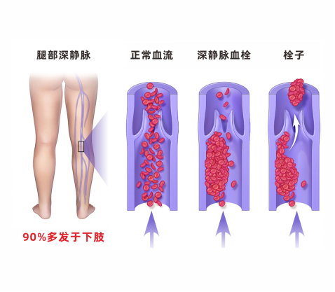 深靜脈血栓類似病癥的認(rèn)識與區(qū)分