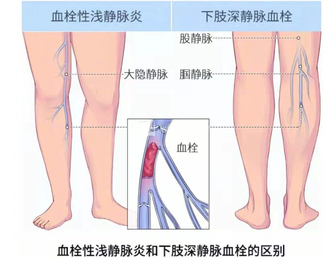 深靜脈血栓類似病癥的認(rèn)識與區(qū)分