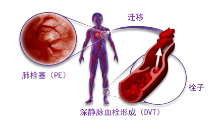 骨科術(shù)后重點(diǎn)關(guān)注的問(wèn)題—VTE，該如何防治？