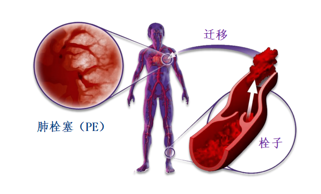 動(dòng)脈血栓和靜脈血栓有什么區(qū)別嗎？