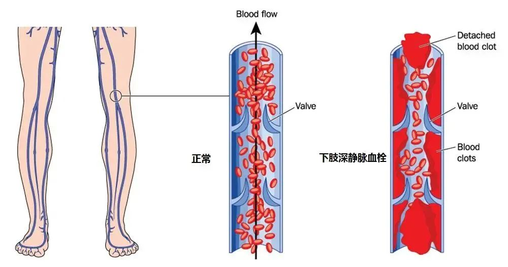 下肢水腫—當(dāng)心