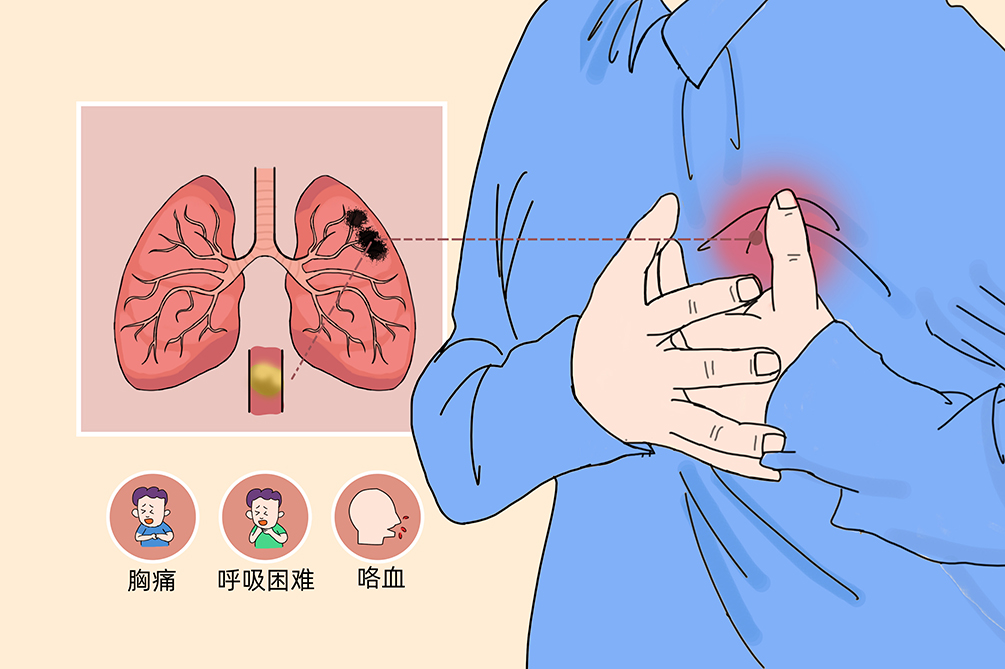 VTE的危害您了解嗎？