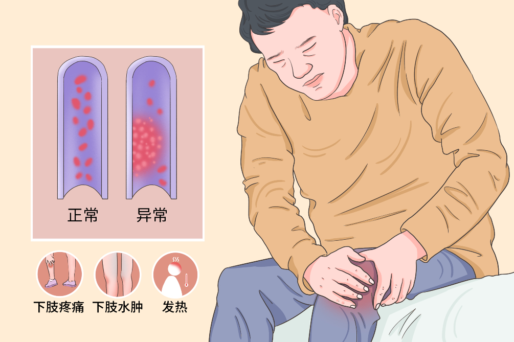 VTE的危害您了解嗎？