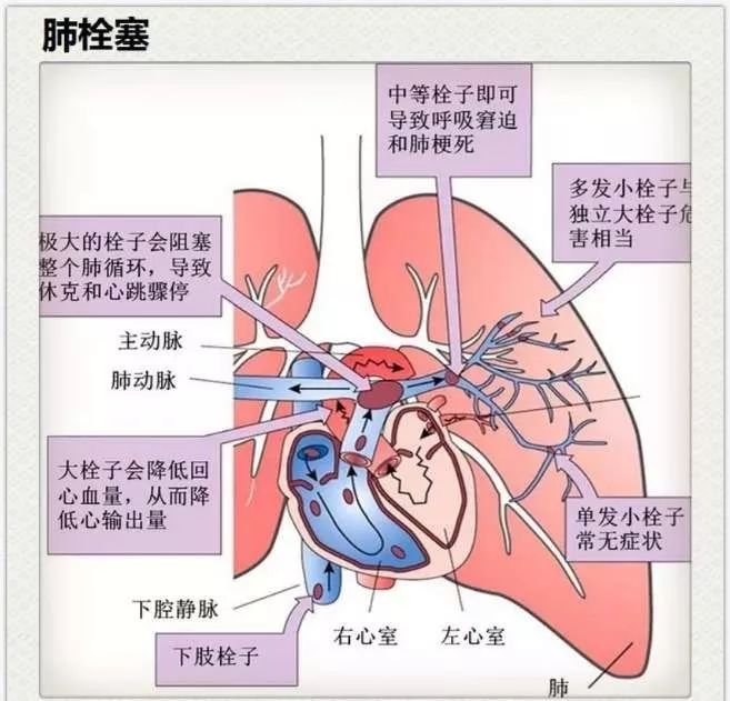 “沉默的殺手”——肺栓塞