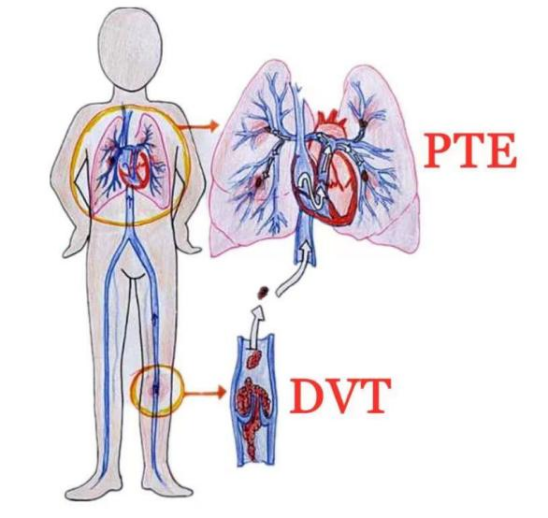 圍生期靜脈血栓栓塞癥（VTE）